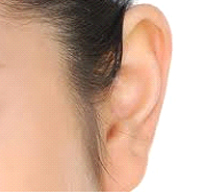 Otoplastia (cirurgia das orelhas)
